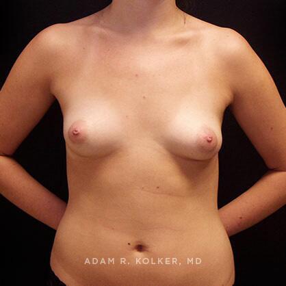 Breast Augmentation Before Image Patient 60 Front View