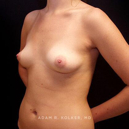 Breast Augmentation Before Image Patient 60 Oblique View