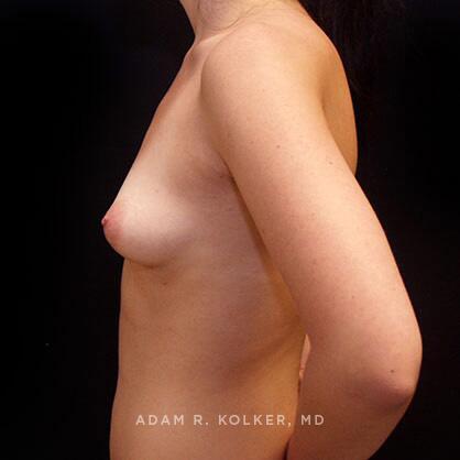 Breast Augmentation Before Image Patient 60 Side View