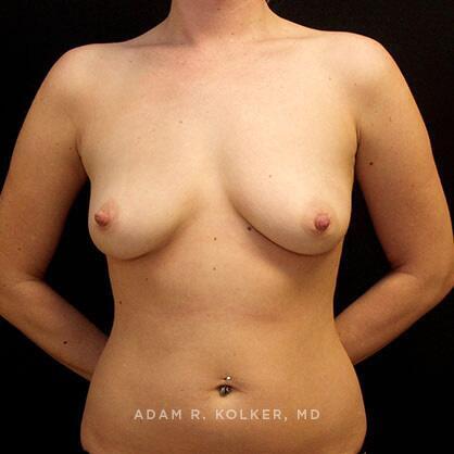 Breast Augmentation Before Image Patient 62 Front View