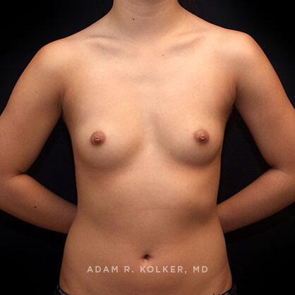 Breast Augmentation Before Image Patient 63 Front View
