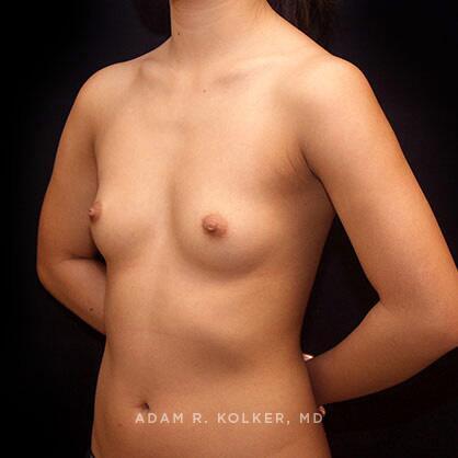 Breast Augmentation Before Image Patient 63 Oblique View