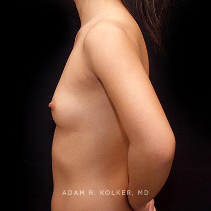 Breast Augmentation Before Image Patient 63 Side View