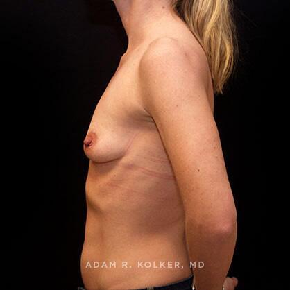 Breast Augmentation Before Image Patient 64 Side View