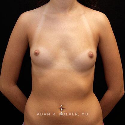 Breast Augmentation Before Image Patient 65 Front View