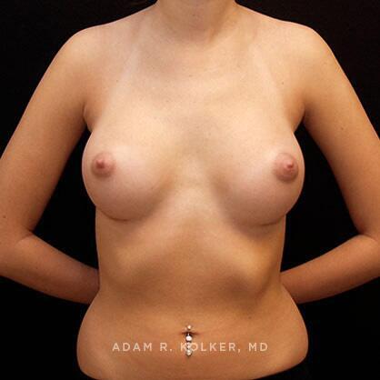 Breast Augmentation After Image Patient 65 Front View