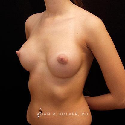 Breast Augmentation After Image Patient 65 Oblique View