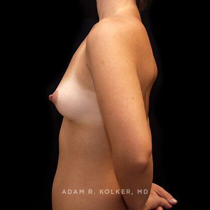 Breast Augmentation Before Image Patient 67 Side View