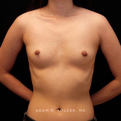 Breast Augmentation Before Image Patient 68 Front View