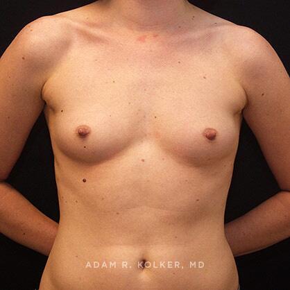 Breast Augmentation Before Image Patient 69 Front View