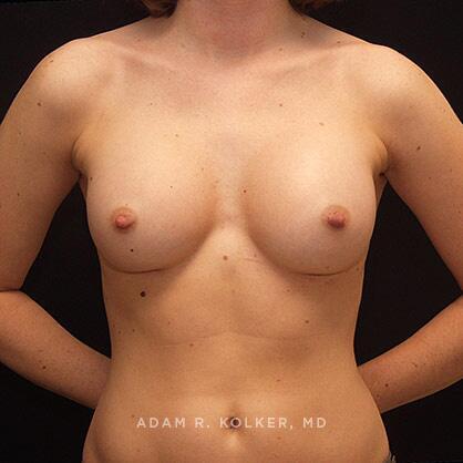 Breast Augmentation After Image Patient 69 Front View