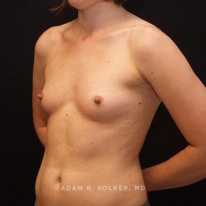 Breast Augmentation Before Image Patient 69 Oblique View