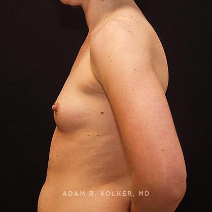 Breast Augmentation Before Image Patient 69 Side View