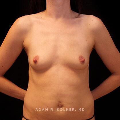 Breast Augmentation Before Image Patient 70 Front View