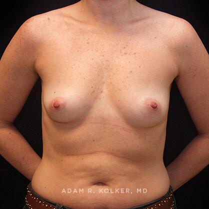Breast Augmentation Before Image Patient 71 Front View