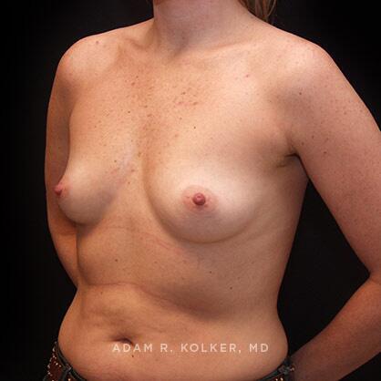 Breast Augmentation Before Image Patient 71 Oblique View