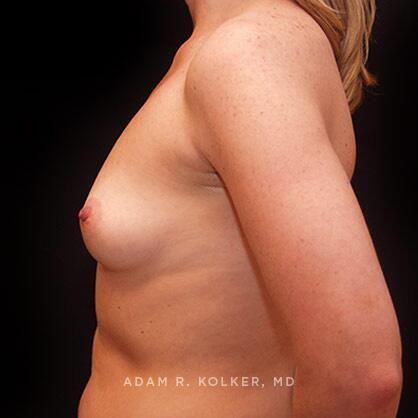 Breast Augmentation Before Image Patient 71 Side View