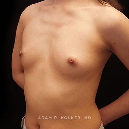 Breast Augmentation Before Image Patient 72 Oblique View