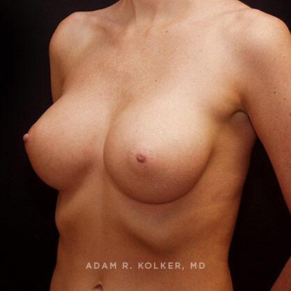 Breast Augmentation After Image Patient 73 Oblique View