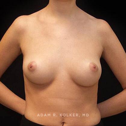 Breast Augmentation Before Image Patient 75 Front View