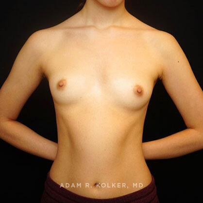 Breast Augmentation Before Image Patient 76 Front View