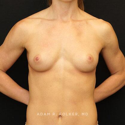 Breast Augmentation Before Image Patient 77 Front View