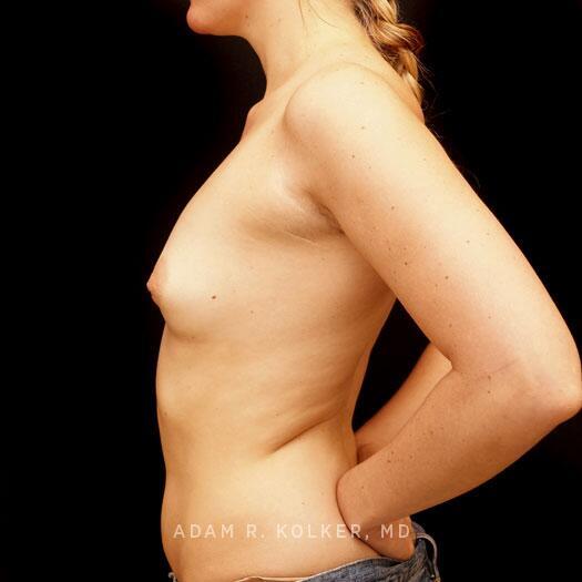 Breast Augmentation Before Image Patient 81 Side View