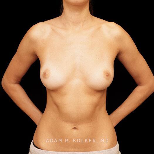 Breast Augmentation Before Image Patient 84 Front View