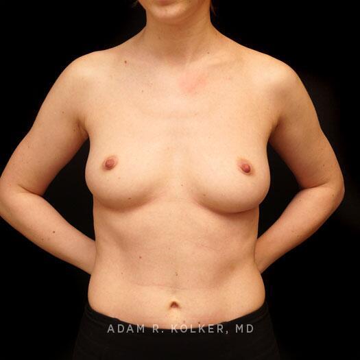Breast Augmentation Before Image Patient 85 Front View