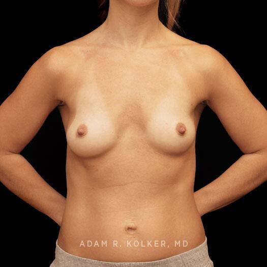 Breast Augmentation Before Image Patient 86 Front View