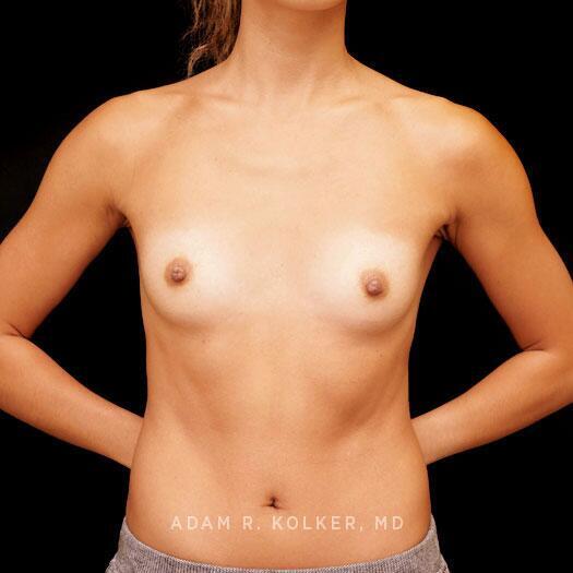 Breast Augmentation Before Image Patient 89 Front View