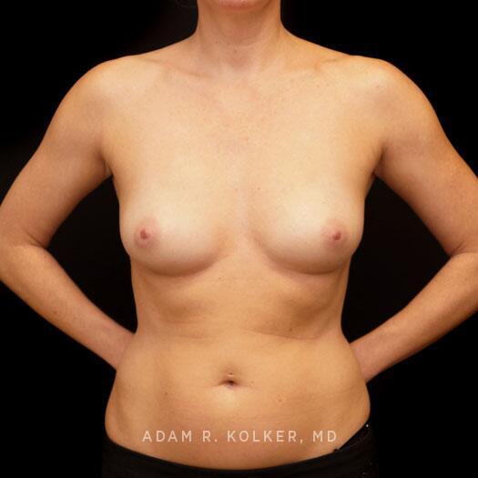 Breast Augmentation Before Image Patient 90 Front View