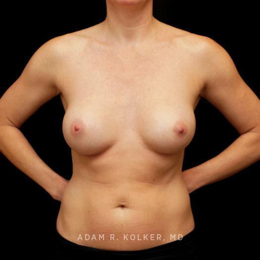 Breast Augmentation After Image Patient 90 Front View