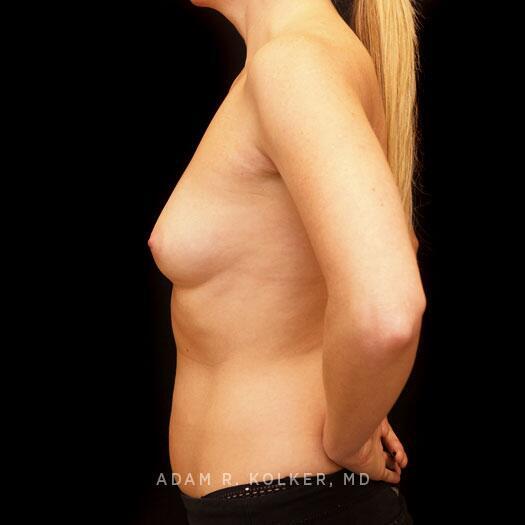 Breast Augmentation Before Image Patient 90 Side View