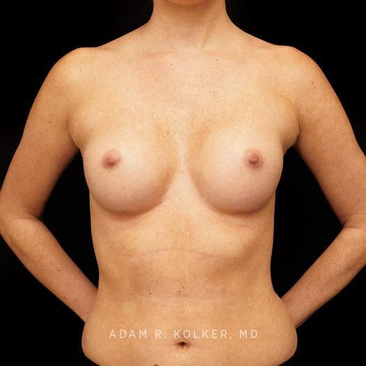 Breast Augmentation After Image Patient 91 Front View