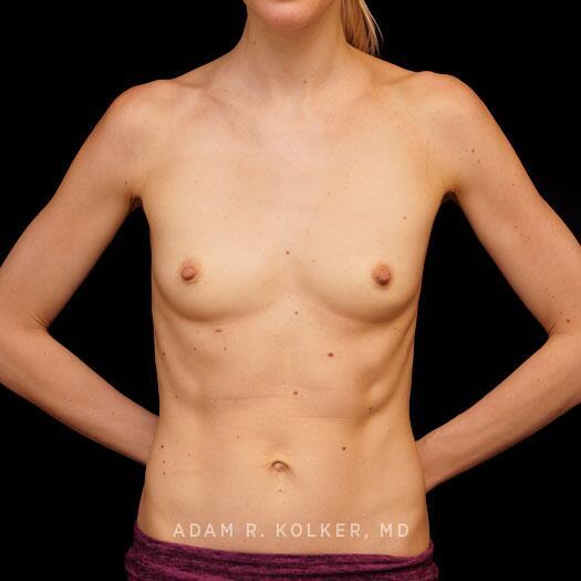 Breast Augmentation Before Image Patient 94 Front View