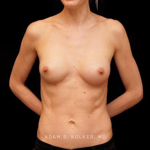 Breast Augmentation After Image Patient 94 Front View