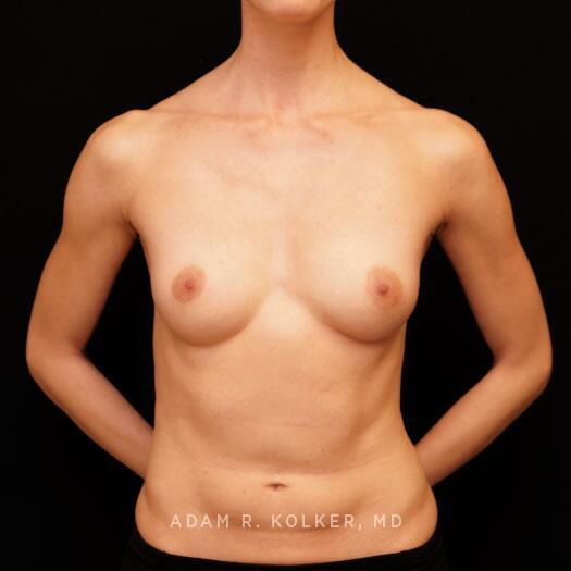 Breast Augmentation Before Image Patient 95 Front View