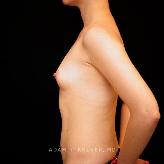 Breast Augmentation After Image Patient 96 Oblique View