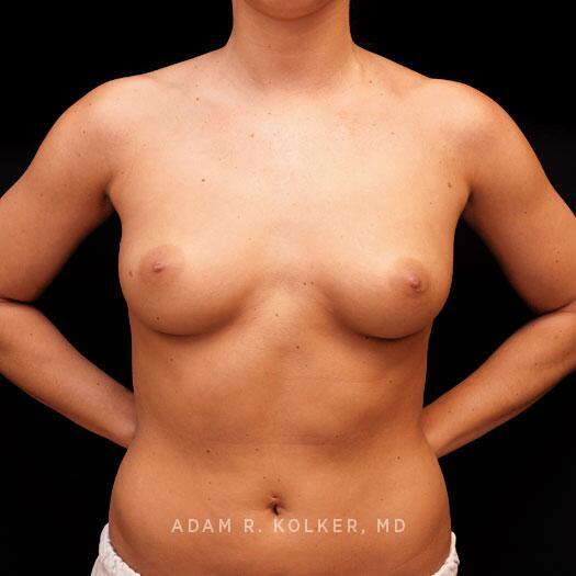 Breast Augmentation Before Image Patient 98 Front View