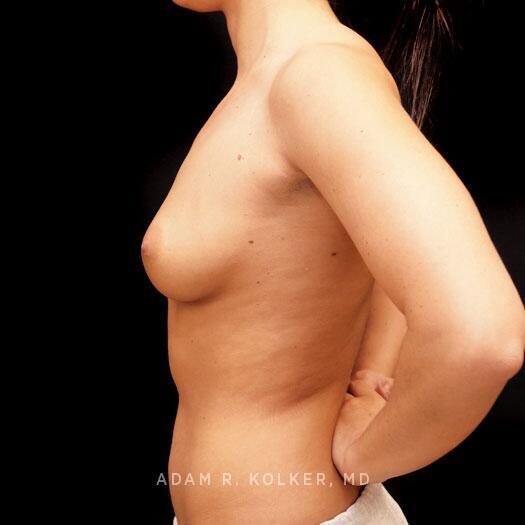 Breast Augmentation Before Image Patient 98 Side View
