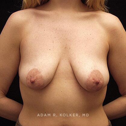 Breast Lift Before Image Patient 07 Front View