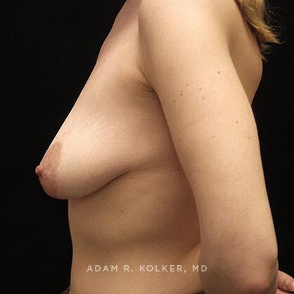 Breast Lift Before Image Patient 07 Side View