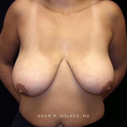 Breast Lift Before Image Patient 09 Front View