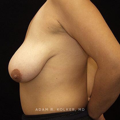 Breast Lift Before Image Patient 09 Side View