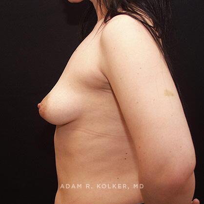 Breast Lift Before Image Patient 11 Side View