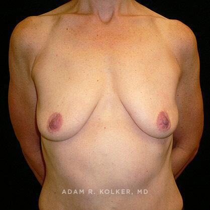 Breast Lift Before Image Patient 12 Front View