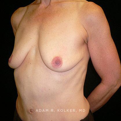 Breast Lift Before Image Patient 12 Oblique View