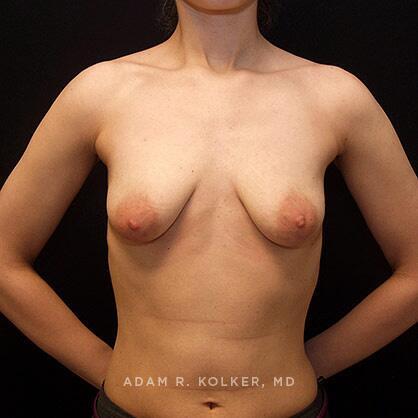 Breast Lift Before Image Patient 13 Front View