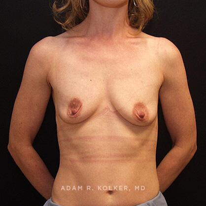 Breast Lift Before Image Patient 15 Front View